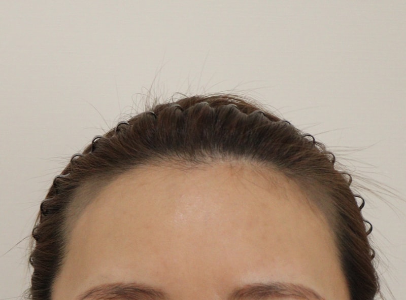 I also had a hair transplant while my husband was having surgery lol
