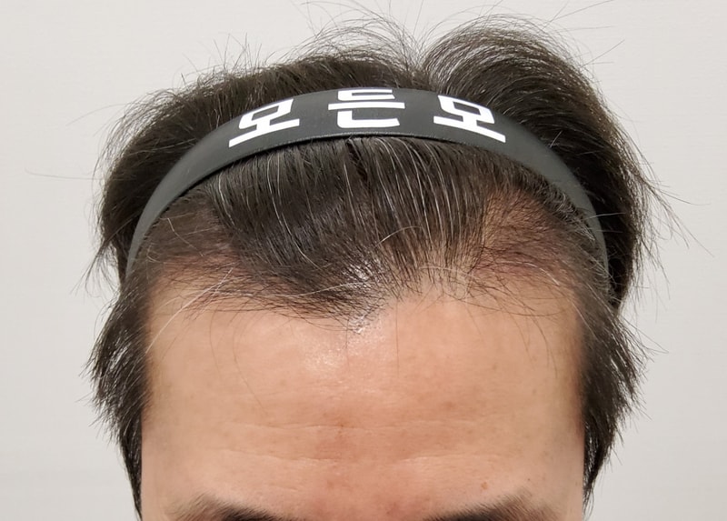 3. 수술후_3개월_1.jpg