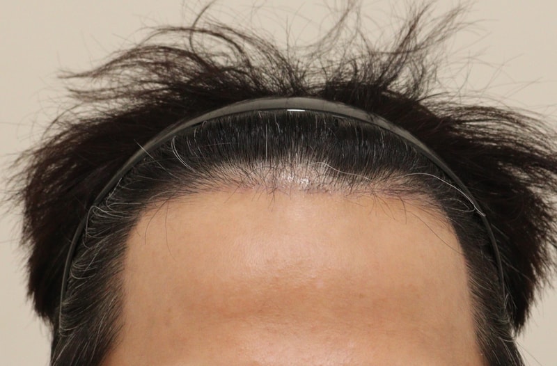 3. 수술후_3개월_1.JPG
