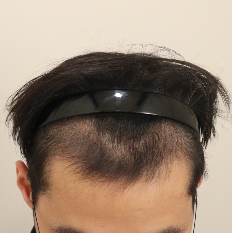 3. 수술후_3개월_2.JPG