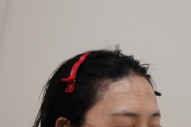 2. 수술후_3.JPG
