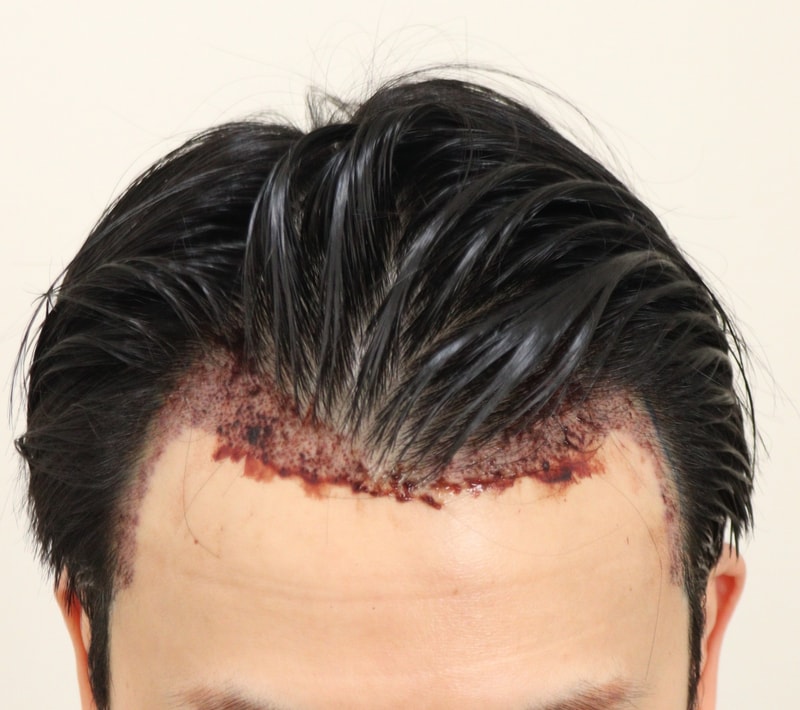 2. 수술후_1일_1.JPG
