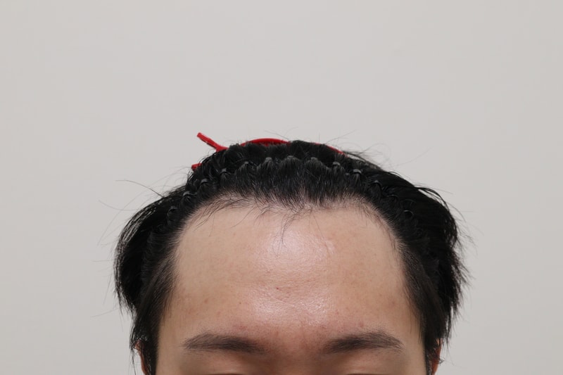 1. 수술전_1.JPG