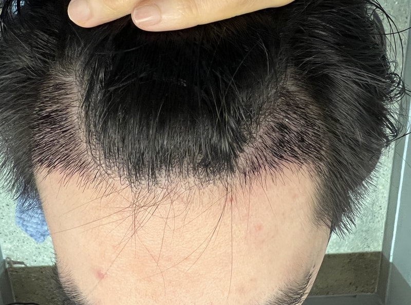 2. 수술후_2주_1.jpg