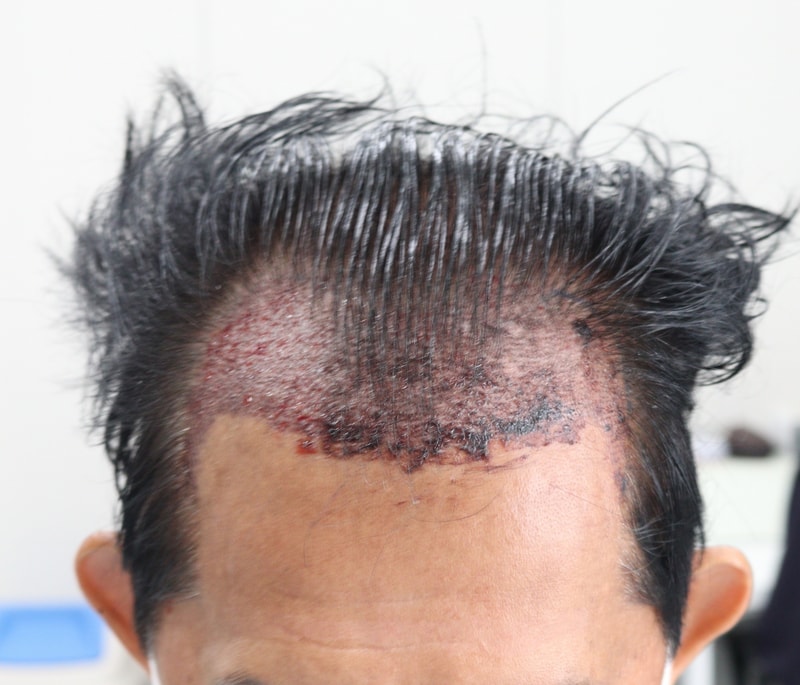 2. 수술후_1일.JPG