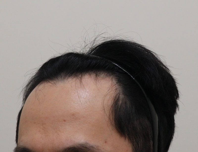 1. 수술전_2.JPG