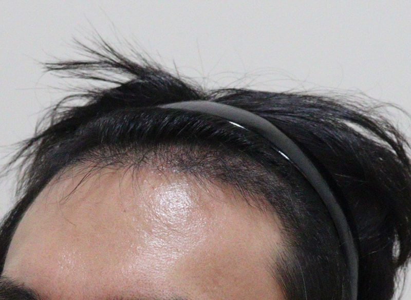 4. 수술후_5개월_2.JPG