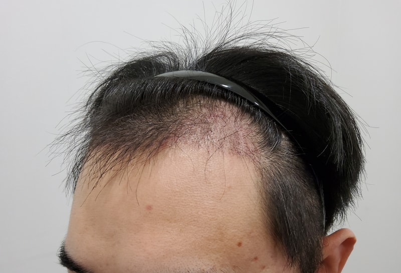 3. 수술후_3개월_2.jpg