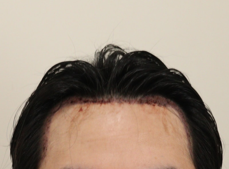 2. 수술후_1일_1.JPG