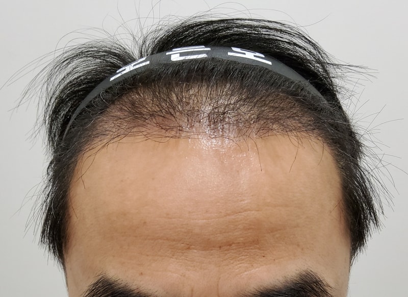 3. 수술후_3개월_1.jpg