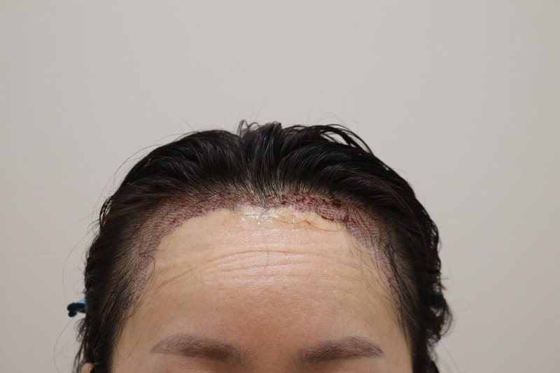 2. 수술후_1일_1.JPG