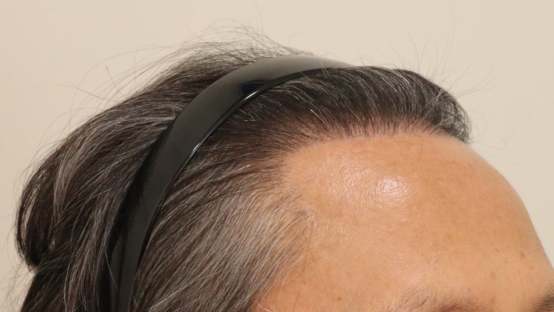 5. 수술후_1년_2.JPG