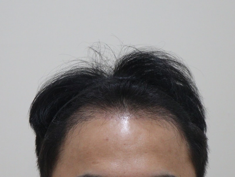 2. 수술후_3개월_1.JPG