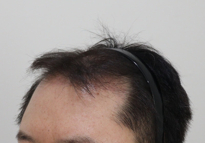 3. 수술후_3개월_2.JPG