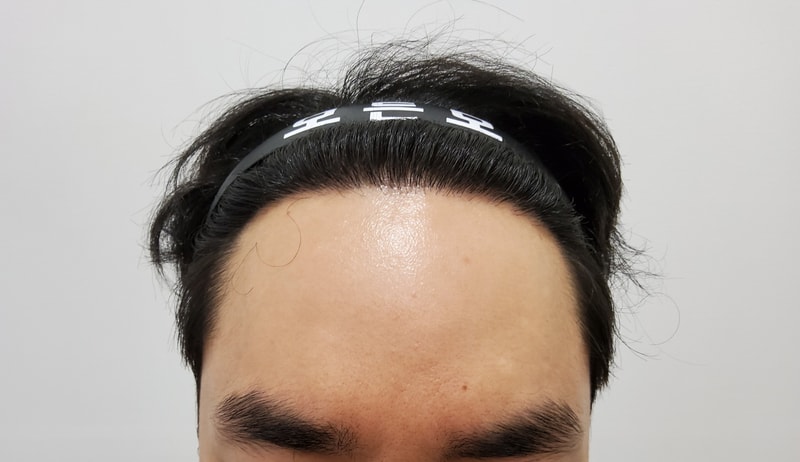 4. 수술후_1년_1.jpg