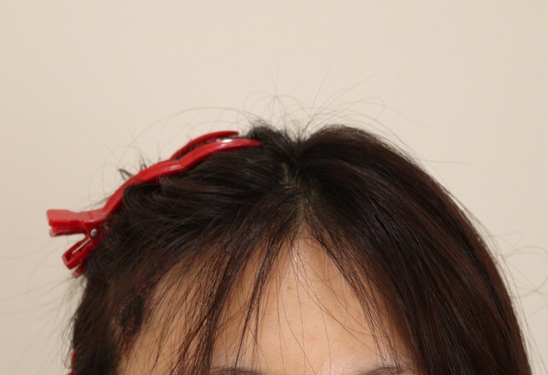 2. 수술후_1일_2.JPG