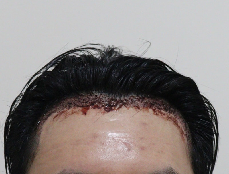 2. 수술후_1일_1.JPG