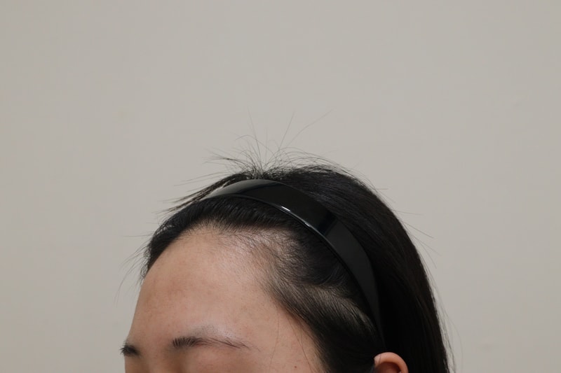 1. 수술전_2.JPG