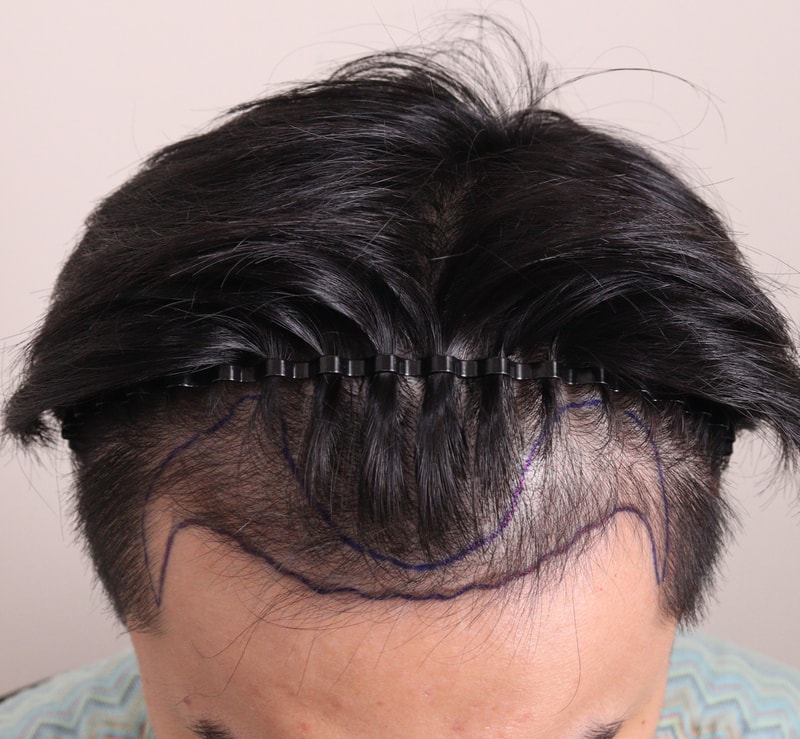 1. 수술전_2.JPG