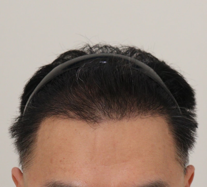 4. 수술후_6개월_1.JPG
