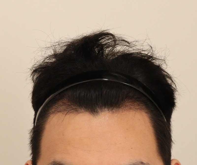 3. 수술후_3개월_1.JPG
