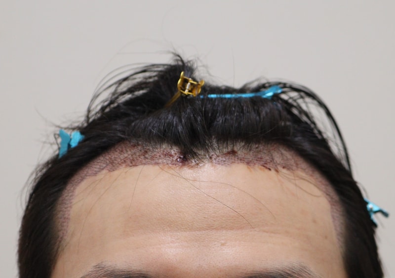 2. 수술후_1일_1.JPG