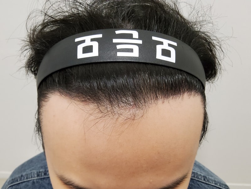 4. 수술후_1년_1.jpg
