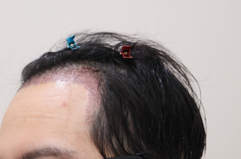2. 수술후_1일_3.JPG