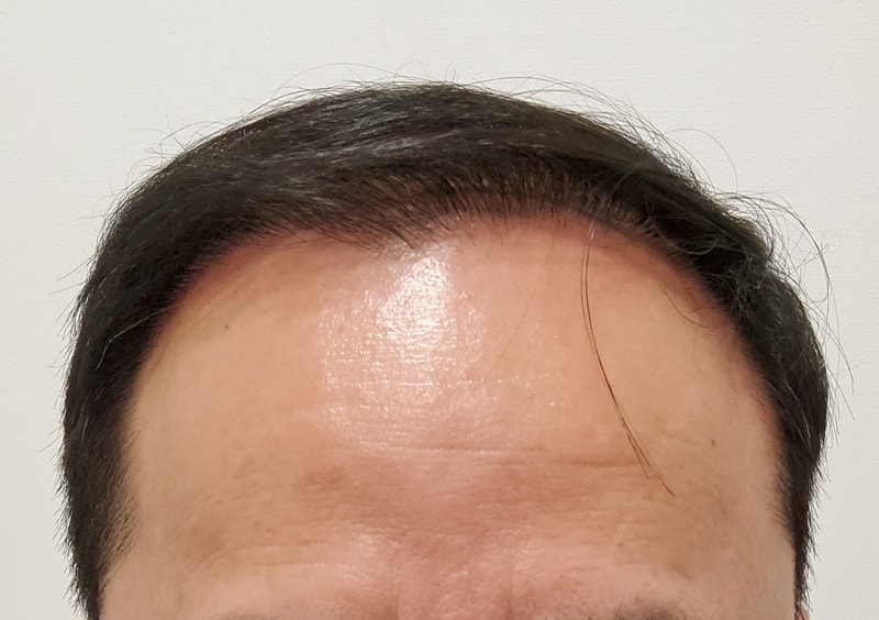 4. 수술후_6개월_1.jpg