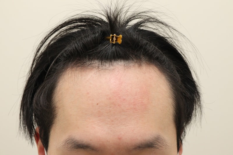 I'm leaving a review of the hair transplant in the 2nd week