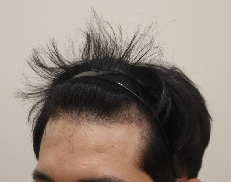 3. 수술후_3개월_2.JPG