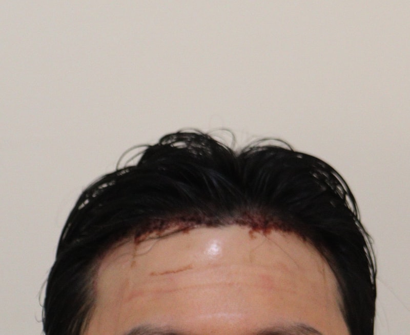 2. 수술후_1일_1.JPG