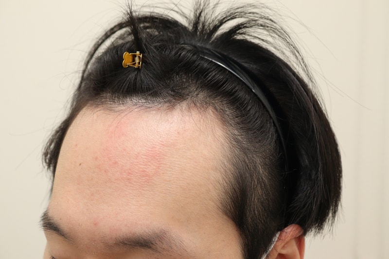 1. 수술전_2.JPG