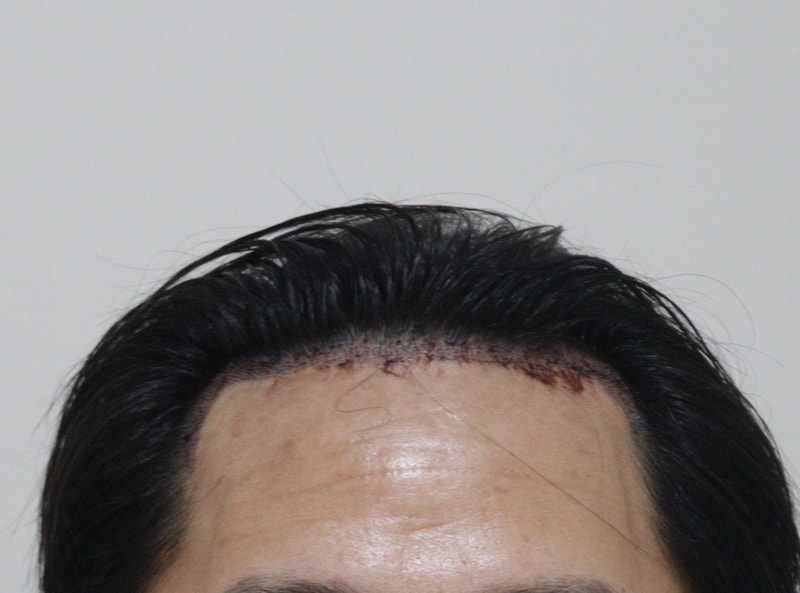 2. 수술후_1일.JPG