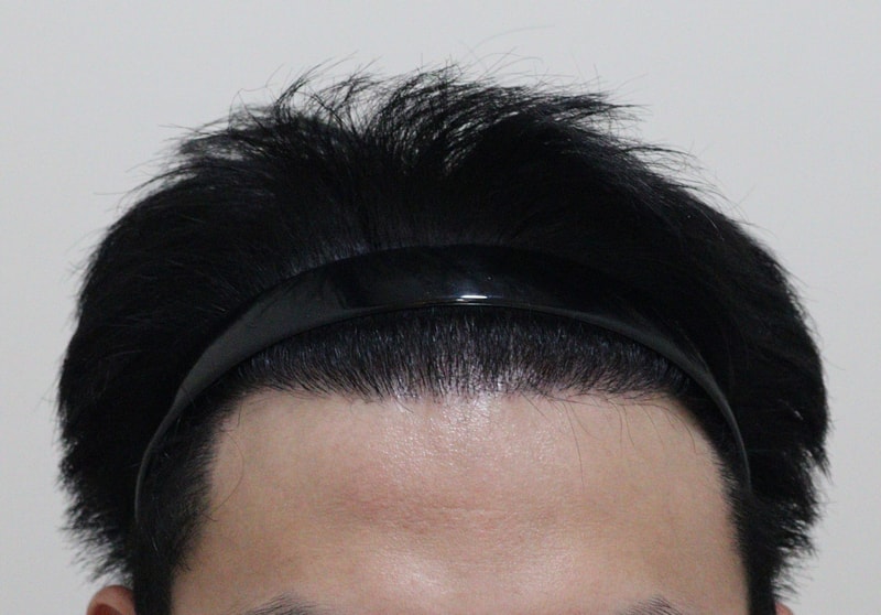5. 수술후_6개월_1.JPG