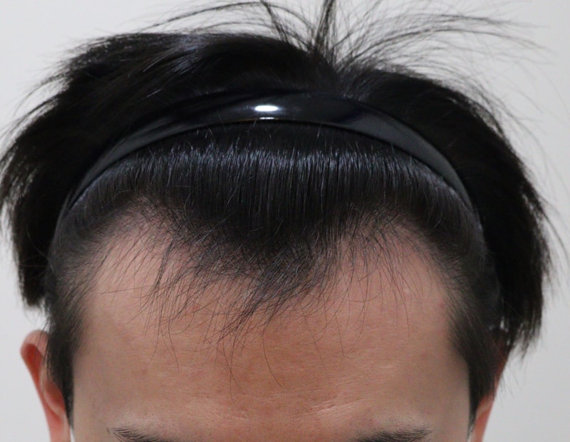 모앤블레스에서 2600모 모발이식 받고 3개월 지났습니다