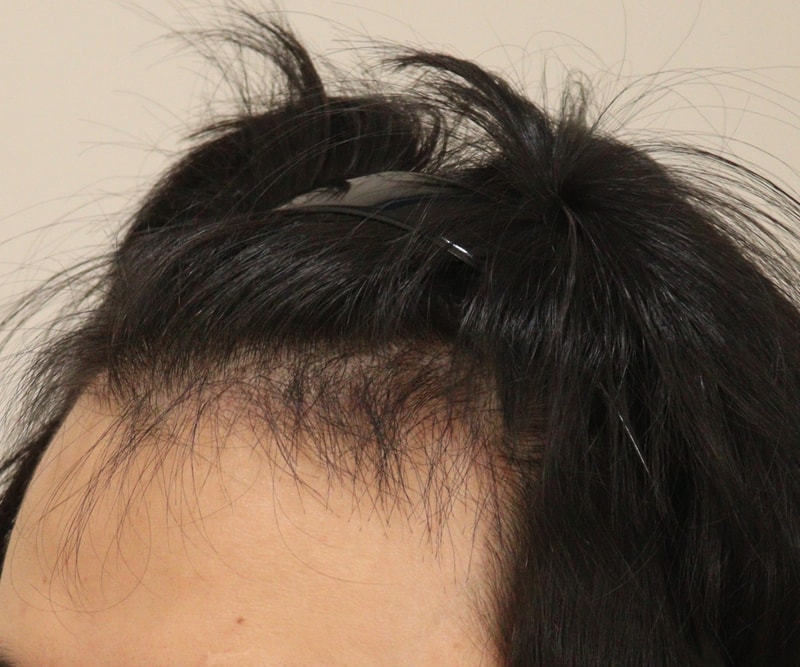 3. 수술후_3개월_3.JPG
