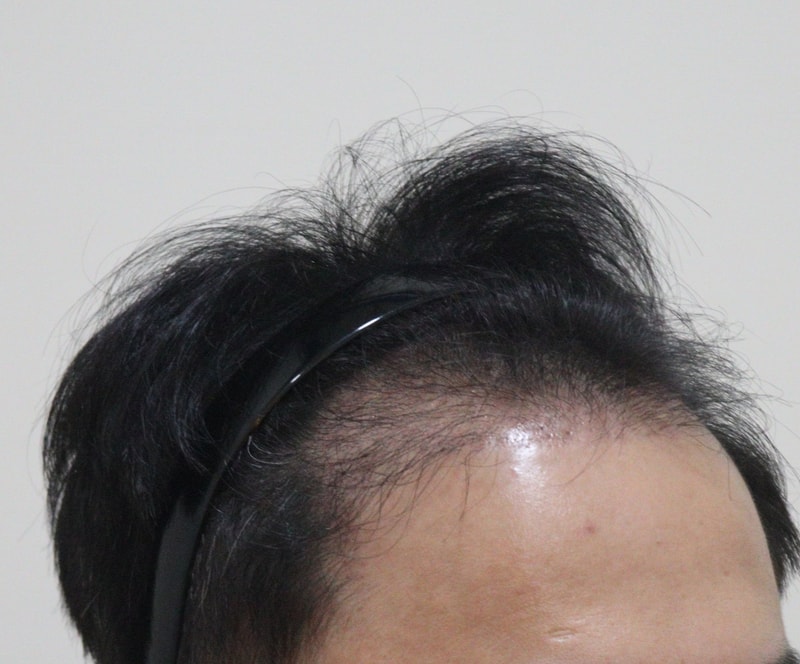 2. 수술후_3개월_3.JPG