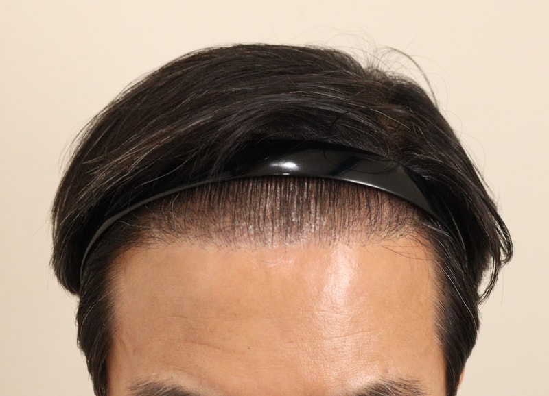 3. 수술후_3개월_1.JPG