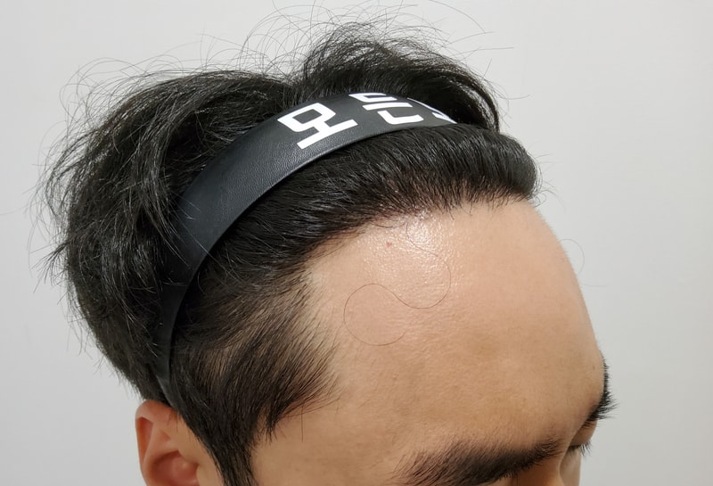 4. 수술후_1년_3.jpg