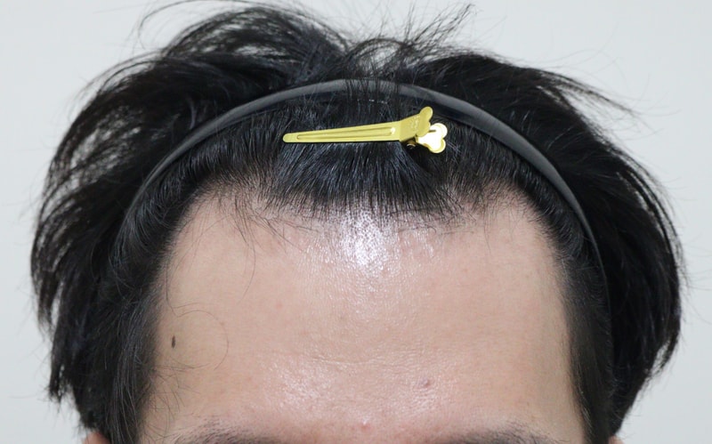 비절개 모발이식 1년차가 되었네요!!!