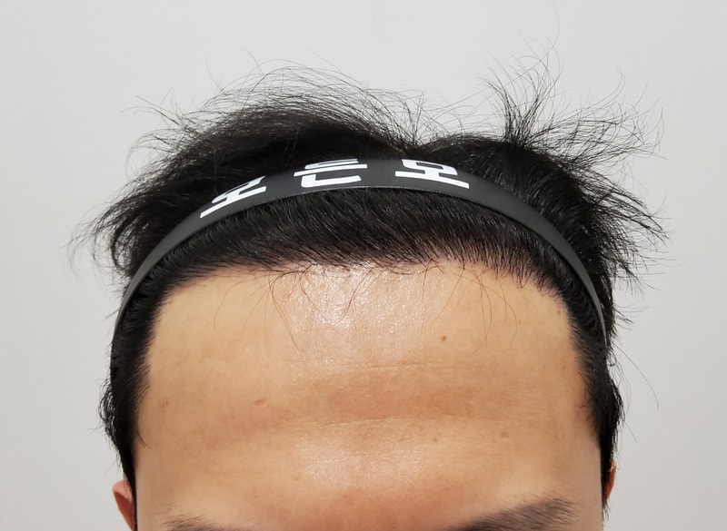 2. 수술후_6개월_1.jpg