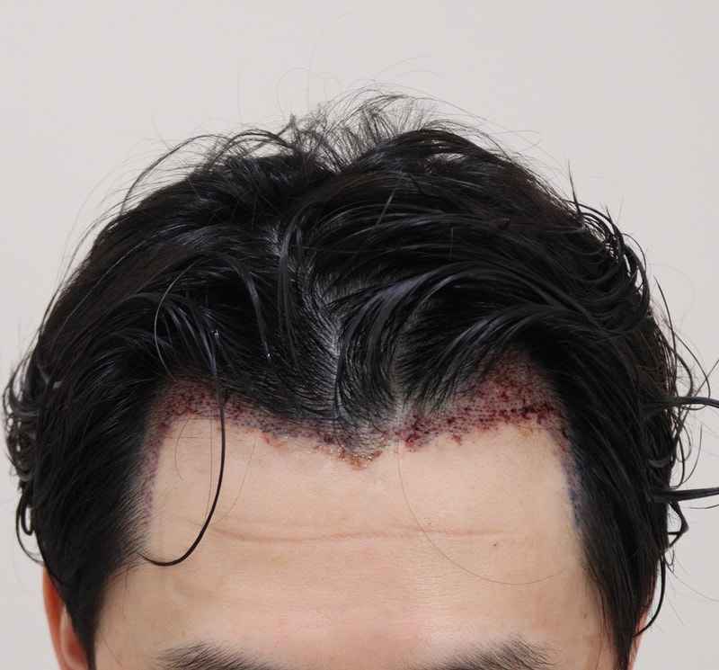 2. 수술후_1일_1.JPG