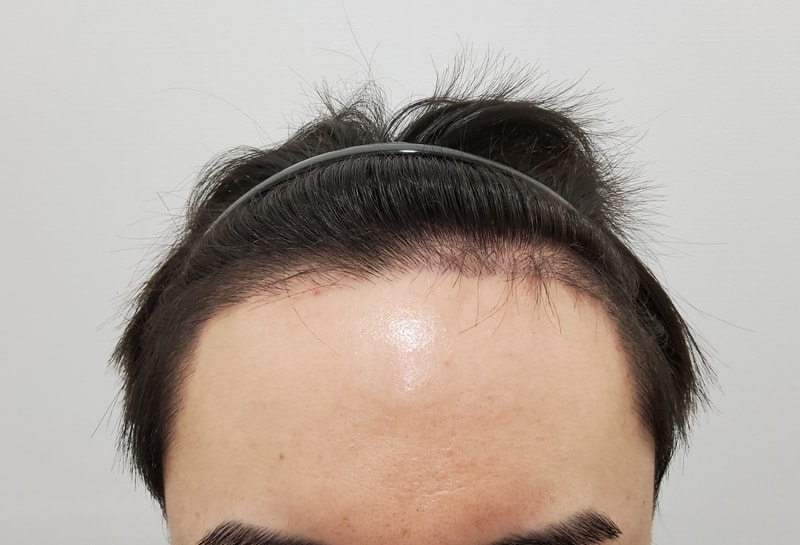 2. 수술후_3개월_1.jpg