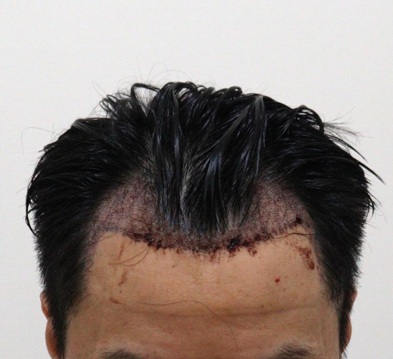 2. 수술후_1일_1.JPG