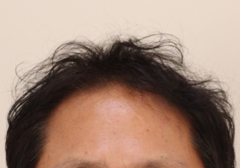 3. 수술후_5개월_1.JPG