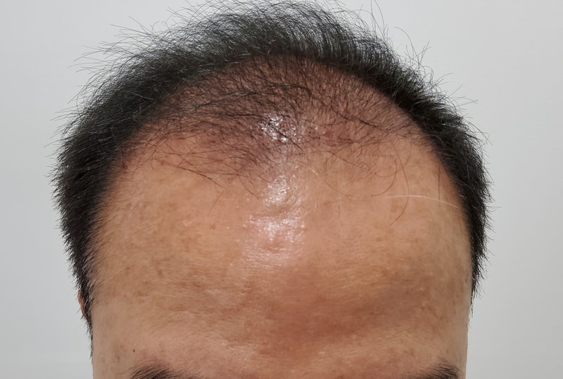 4. 수술후_3개월_1.jpg