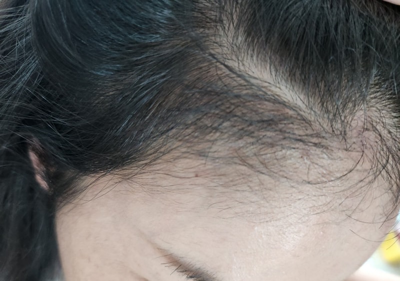 3. 수술후_3개월_셀카_3.jpg