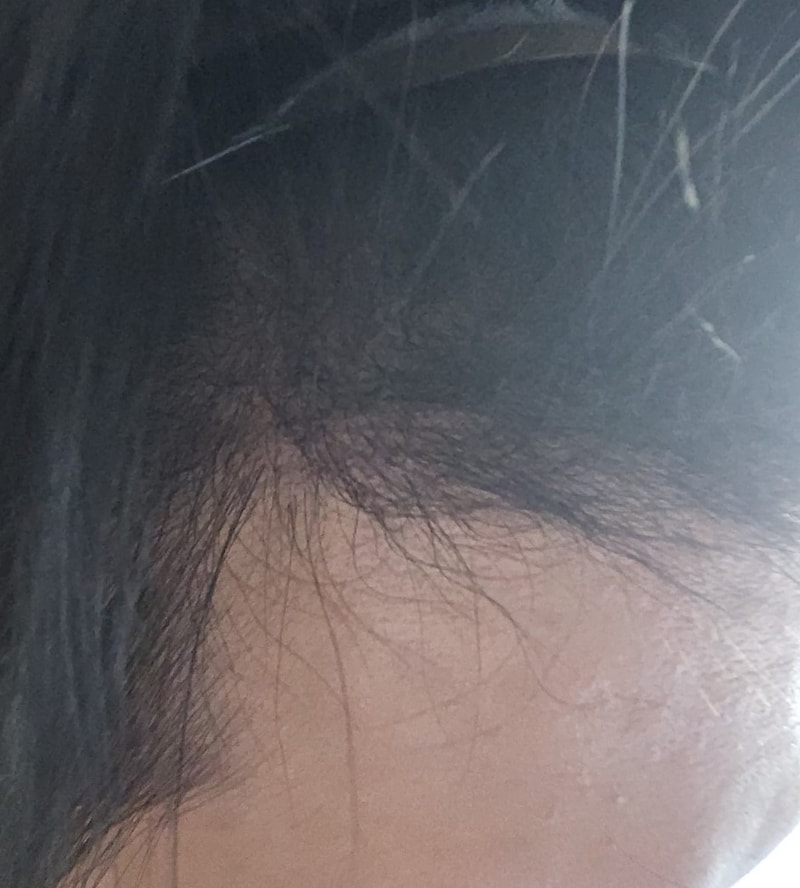 4. 수술후_6개월_셀카_3.jpg