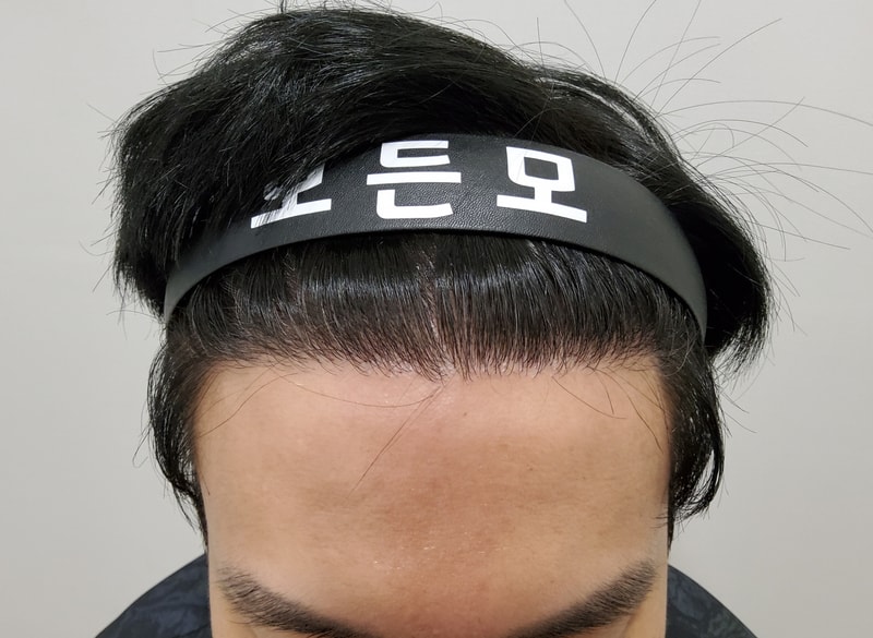 4. 수술후_1년_1.jpg